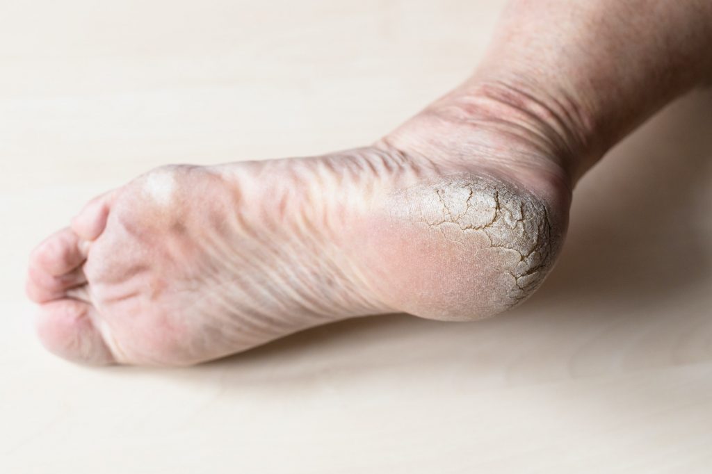 rough cracked skin on heel of male foot